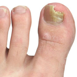 Example 1: fungal nail infection