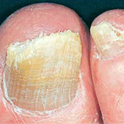 Example 2: fungal nail infection