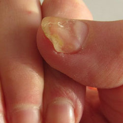 Example 3: fungal nail infection