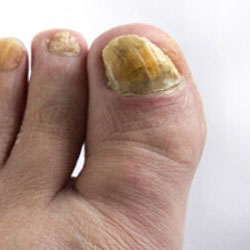 Example 4: fungal nail infection