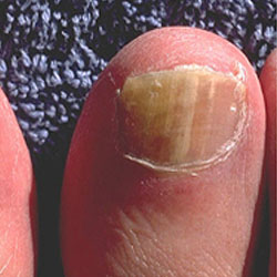 Example 5: fungal nail infection