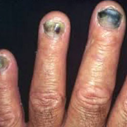 Example 6: fungal nail infection