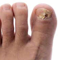 Example 7: fungal nail infection