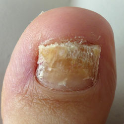 Example 8: fungal nail infection