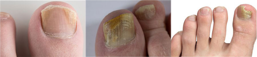 Fungal nail infection before and after