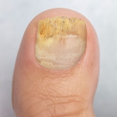 Fungal nail 1