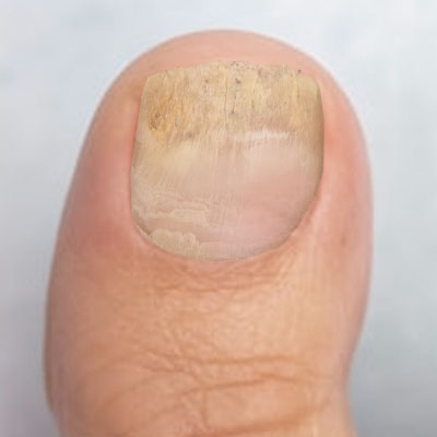 Fungal nail 2