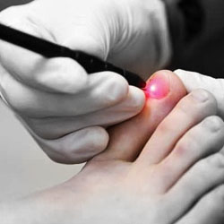 Laser treatment against fungal nail