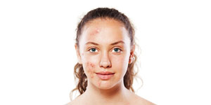 Acne behandeling | Alles wat je moet weten over acné
