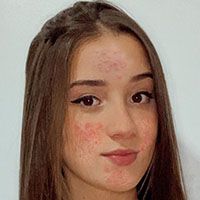 acne picture 3